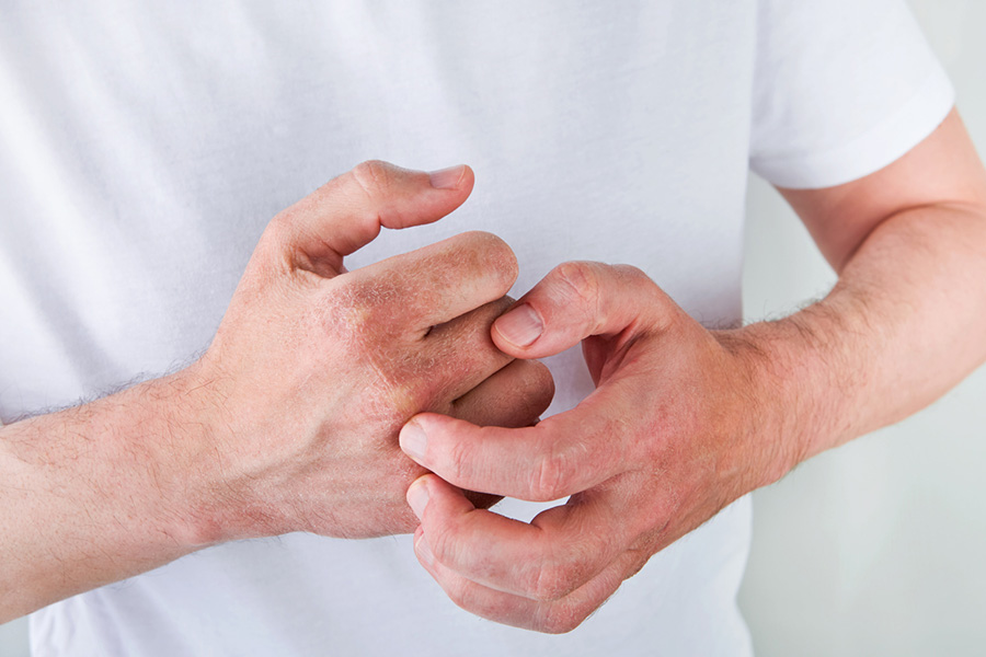 Man scratches or shows hands with dry, cracked skin